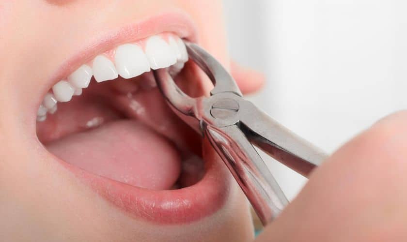 Cât timp durează vindecarea după o extracție dentară?