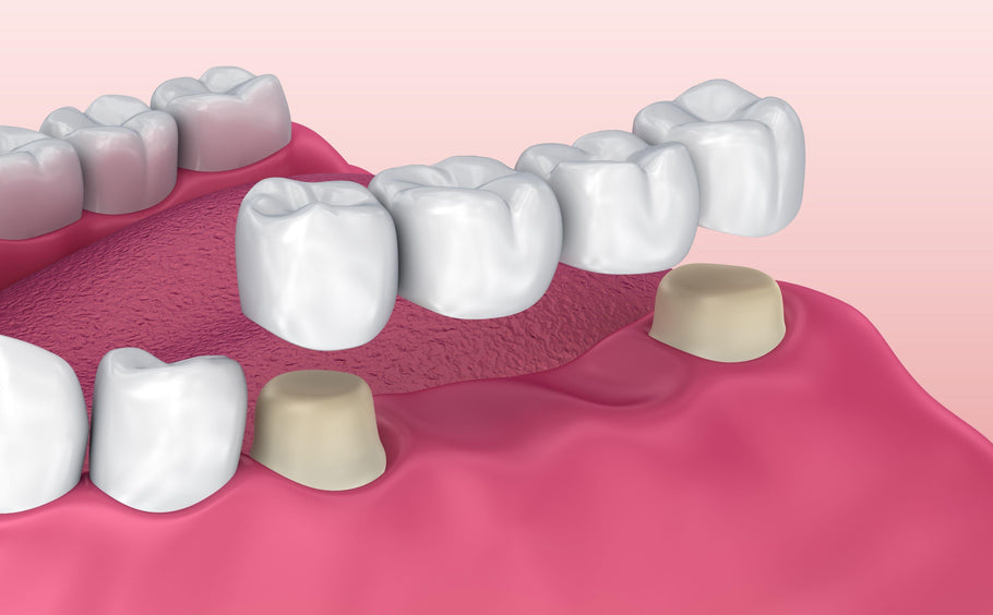 What is a Tooth Bridge?