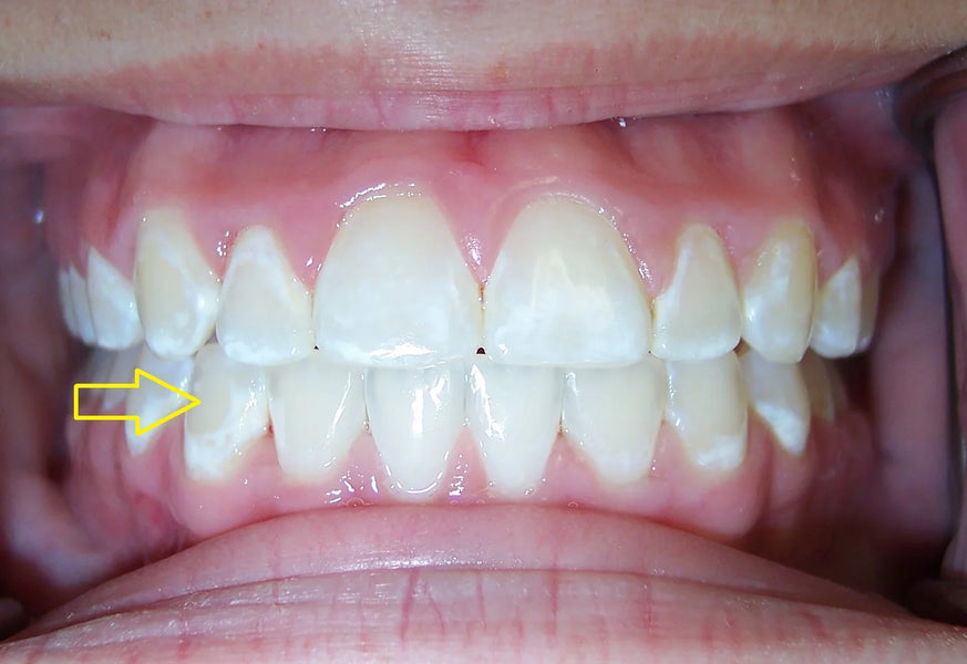 How to Get Rid of White Scars on Teeth