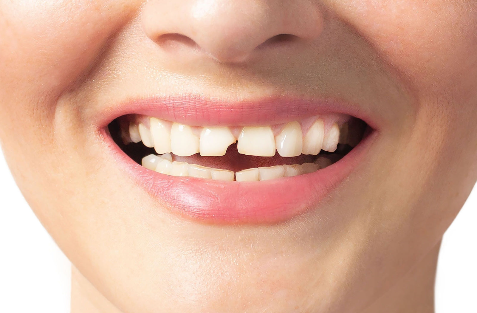 What Should I Get to Hide My Chipped Front Tooth?